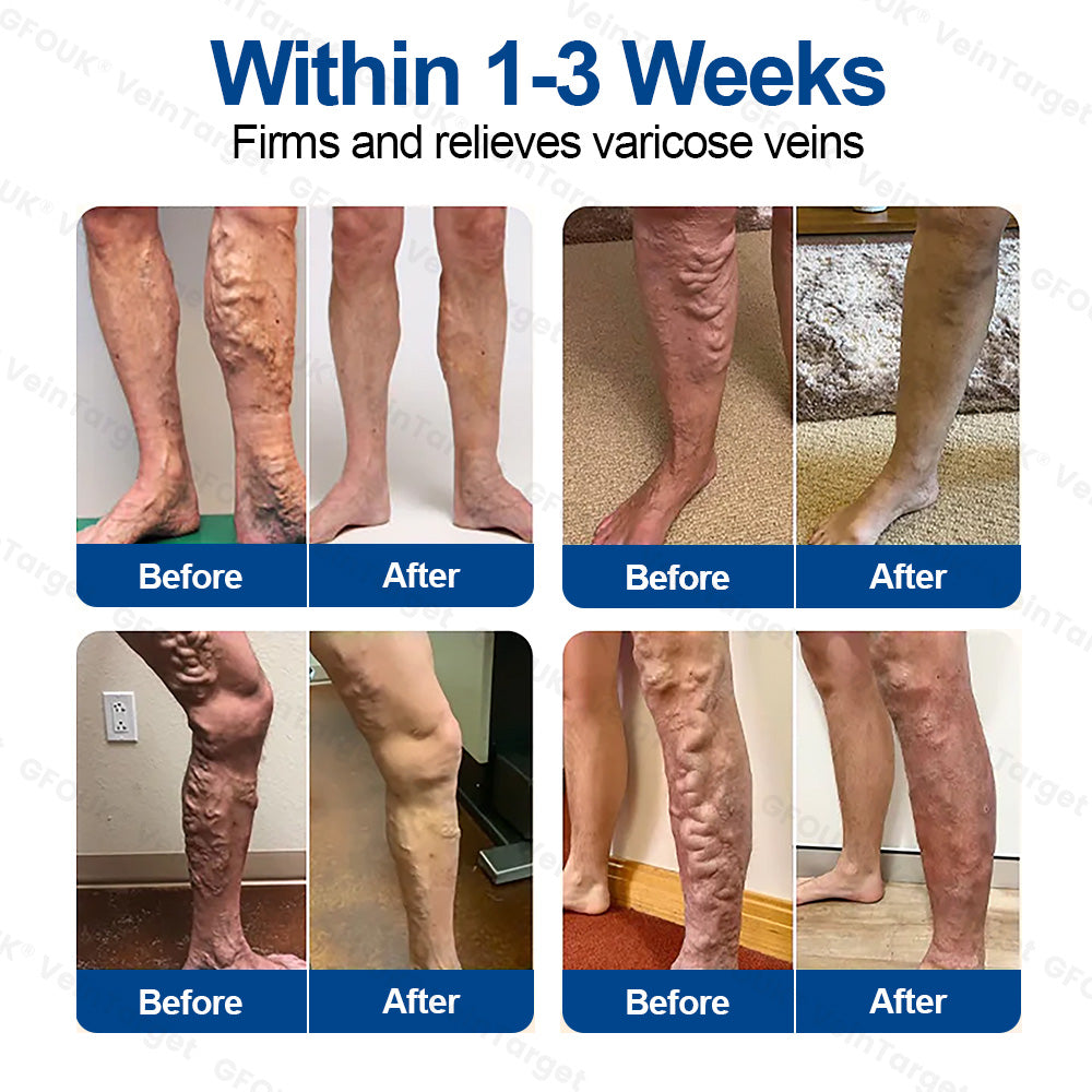 🇬🇧👨‍⚕️✨ CURALONA® VeinTarget Microneedle Patch ⚡ Fast Relief, Long-Lasting Support
