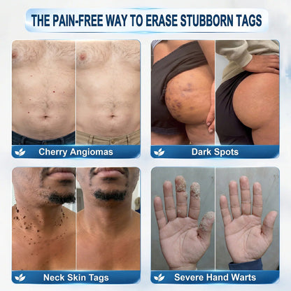 𝐏𝐔𝐑𝐄𝐋𝐎𝐑𝐀® 𝟕-𝐃𝐚𝐲 𝐒𝐤𝐢𝐧 𝐓𝐚𝐠 & 𝐒𝐩𝐨𝐭 𝐑𝐞𝐦𝐨𝐯𝐚𝐥 𝐂𝐫𝐞𝐚𝐦 (𝐏𝐚𝐢𝐧𝐥𝐞𝐬𝐬 𝐅𝐨𝐫𝐦𝐮𝐥𝐚 – 𝐍𝐨 𝐒𝐜𝐚𝐫𝐫𝐢𝐧𝐠) 🌹🌹