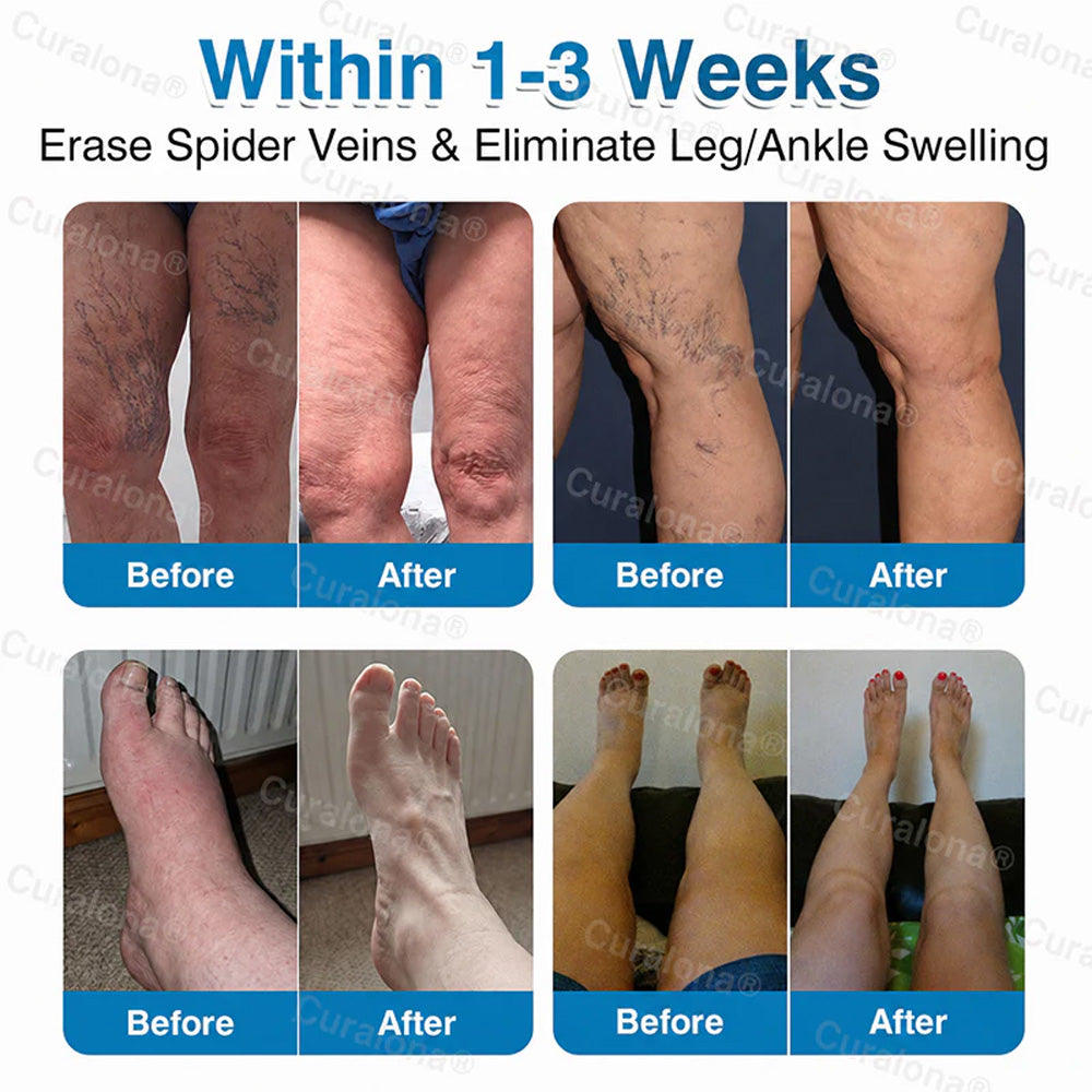 🇬🇧🏆✅️🏃 Curalona® VeinRepair Microneedle Patch Roll ⚡ Instant Relief, Long-Term Results