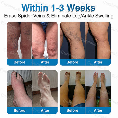🇬🇧🏆✅️🏃 Curalona® VeinRepair Microneedle Patch Roll ⚡ Instant Relief, Long-Term Results