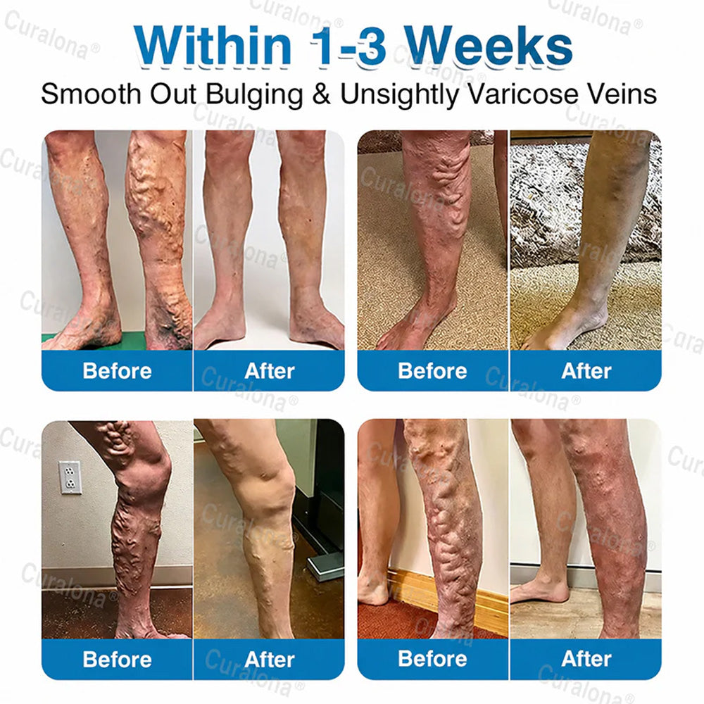 🇬🇧🏆✅️🏃 Curalona® VeinRepair Microneedle Patch Roll ⚡ Instant Relief, Long-Term Results