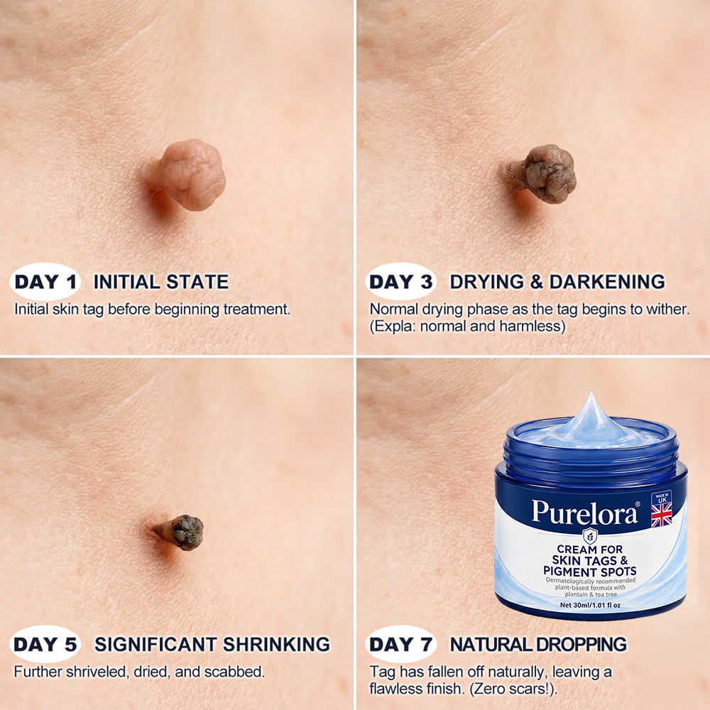 𝐏𝐔𝐑𝐄𝐋𝐎𝐑𝐀® 𝟕-𝐃𝐚𝐲 𝐒𝐤𝐢𝐧 𝐓𝐚𝐠 & 𝐒𝐩𝐨𝐭 𝐑𝐞𝐦𝐨𝐯𝐚𝐥 𝐂𝐫𝐞𝐚𝐦 (𝐏𝐚𝐢𝐧𝐥𝐞𝐬𝐬 𝐅𝐨𝐫𝐦𝐮𝐥𝐚 – 𝐍𝐨 𝐒𝐜𝐚𝐫𝐫𝐢𝐧𝐠) 🌹🌹