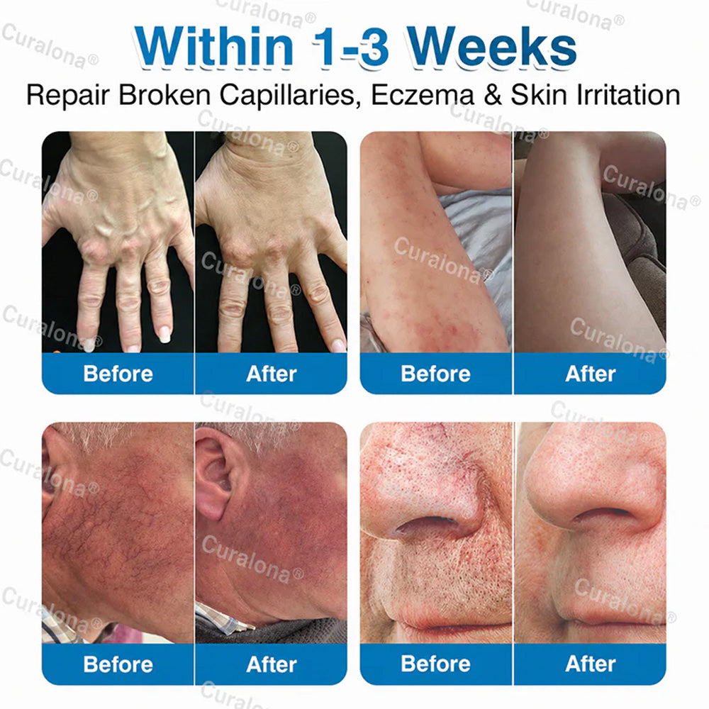 🇬🇧🏆✅️🏃 Curalona® VeinRepair Microneedle Patch Roll ⚡ Instant Relief, Long-Term Results