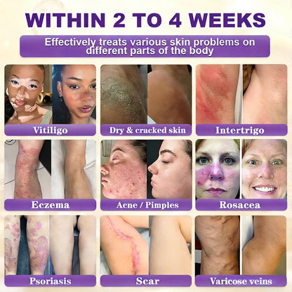 Made and Shipped from the UK 🍁 Purelora® Biotin 10-in-1 Skin Repair Cream — Last Day of Sale: 90% Off