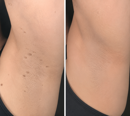 ✨Curalona®2-in-1 Microneedle & Hydrocolloid Patch🍀| Removes Raised Moles, Acne, Flat Warts & Skin Tags | Helps Improve Wrinkles, Scars & Blemishes | Invisible Patches for Face & Body
